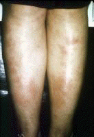 Erythema nodosa. Courtesy of Walter Reed Army Medi