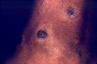 Lichen planus (hypertrophic type). Courtesy of Wal