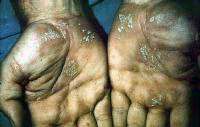 Lichen planus. Courtesy of Walter Reed Army Medica