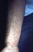 Lichen planus (volar wrist). Courtesy of Walter Re