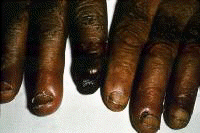 Cold agglutinin disease indistinguishable from cry