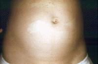 Urticaria (secondary to penicillin). Courtesy of W